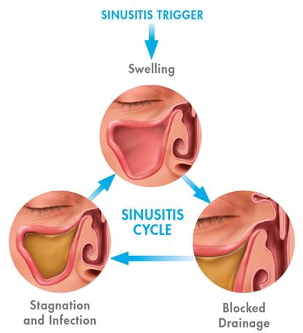 Sinus Infection Diagnosis